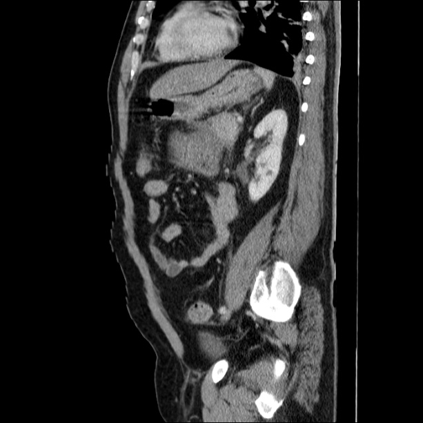 Acute pancreatitis (Radiopaedia 26663-26813 Sagittal C+ portal venous phase 50).jpg