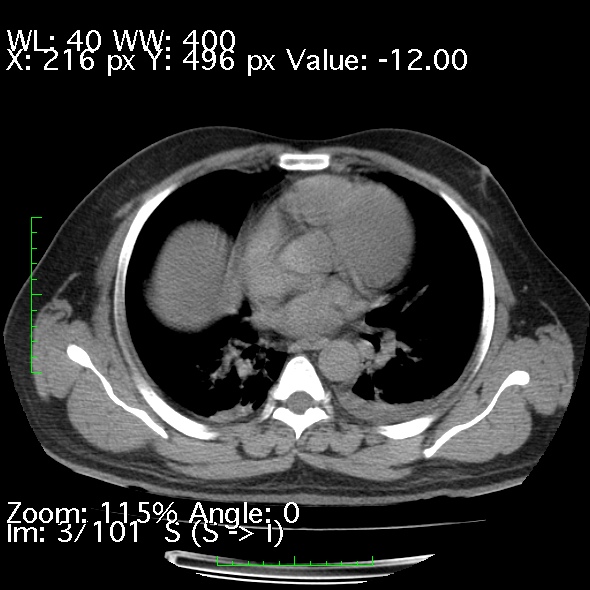Acute pancreatitis (Radiopaedia 34043-35276 Axial non-contrast 3).jpg