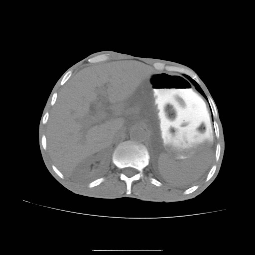 File:Acute pancreatitis (Radiopaedia 50213-55558 Axial non-contrast 3).jpg