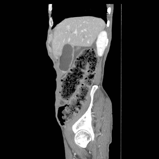 File:Acute pancreatitis (Radiopaedia 50213-55558 Sagittal C+ portal venous phase 6).jpg