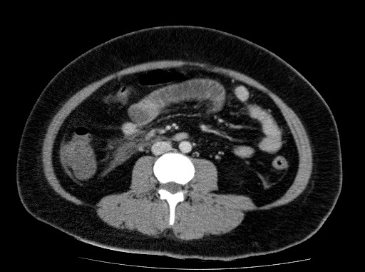 Acute pancreatitis (Radiopaedia 69236-79012 Axial C+ portal venous phase 52).jpg