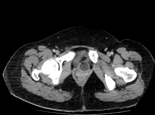 Acute pancreatitis (Radiopaedia 69236-79012 Axial C+ portal venous phase 88).jpg