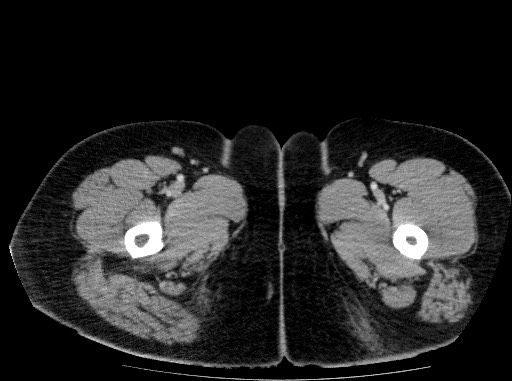 Acute pancreatitis (Radiopaedia 69236-79012 Axial C+ portal venous phase 98).jpg