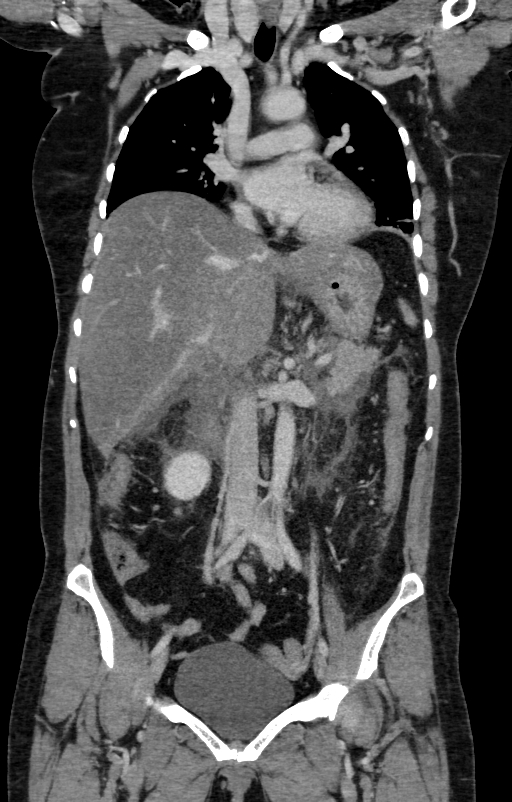Acute pancreatitis (Radiopaedia 80007-93285 Coronal C+ portal venous phase 53).jpg