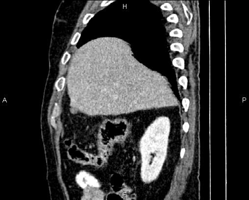 Acute pancreatitis (Radiopaedia 85146-100701 Sagittal C+ portal venous phase 17).jpg