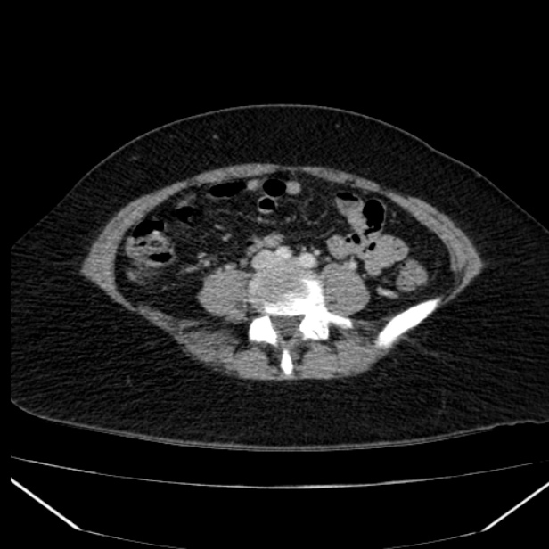 Acute pancreatitis - Balthazar C (Radiopaedia 26569-26714 Axial C+ portal venous phase 64).jpg