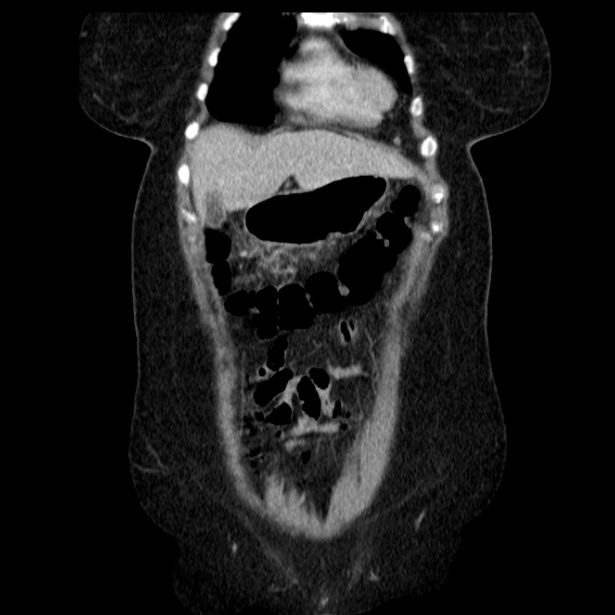 Acute pancreatitis - Balthazar C (Radiopaedia 26569-26714 Coronal C+ portal venous phase 18).jpg