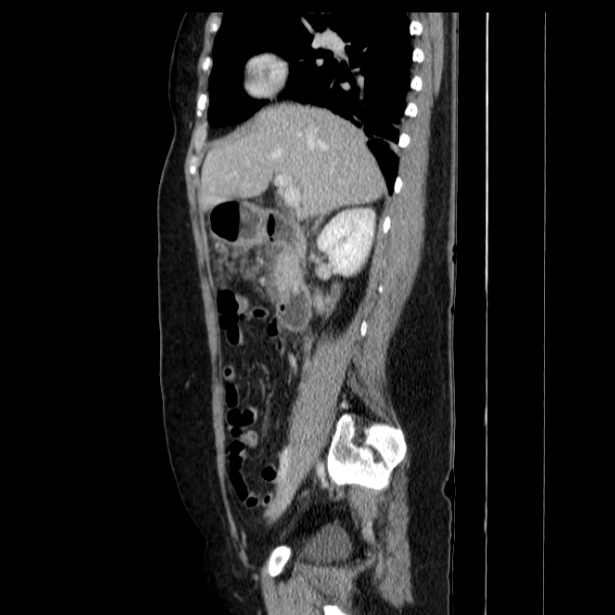 Acute pancreatitis - Balthazar C (Radiopaedia 26569-26714 Sagittal C+ portal venous phase 27).jpg