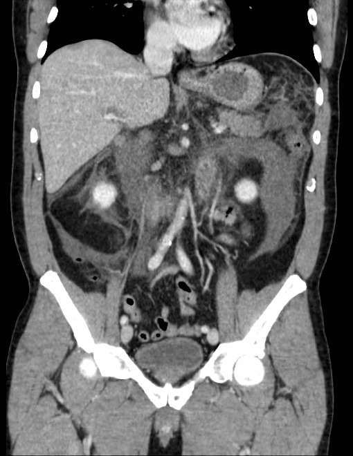 Acute pancreatitis - Balthazar E (Radiopaedia 23080-23110 Coronal C+ portal venous phase 40).jpg
