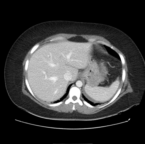 File:Acute pancreatitis - Balthazar E (Radiopaedia 29016-29377 Axial C+ portal venous phase 12).png