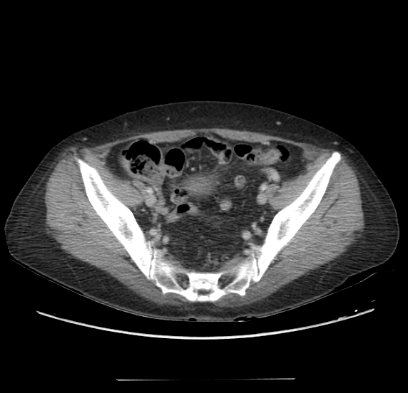 File:Acute pancreatitis - Balthazar E - post ERCP (Radiopaedia 27562-27772 Axial C+ portal venous phase 63).png