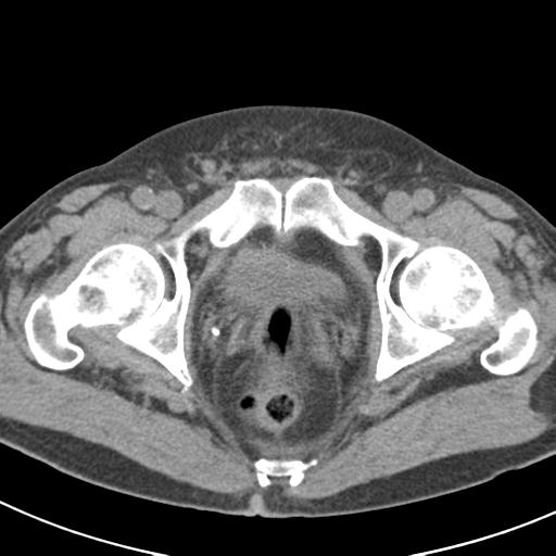 File:Acute pancreatitis and walled-off necrosis (Radiopaedia 29888-30403 Axial non-contrast 74).jpg