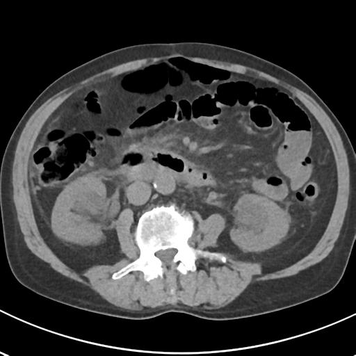 File:Acute pancreatitis and walled-off necrosis (Radiopaedia 29888-30404 Axial non-contrast 39).jpg