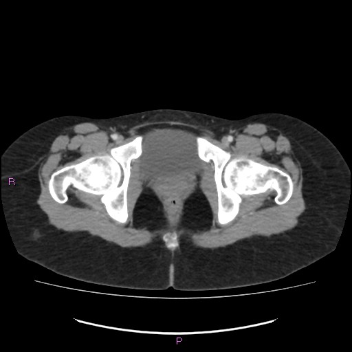Acute pancreatitis secondary to stone at minor papilla and pancreatic divisum (Radiopaedia 76570-88333 Axial C+ portal venous phase 80).jpg