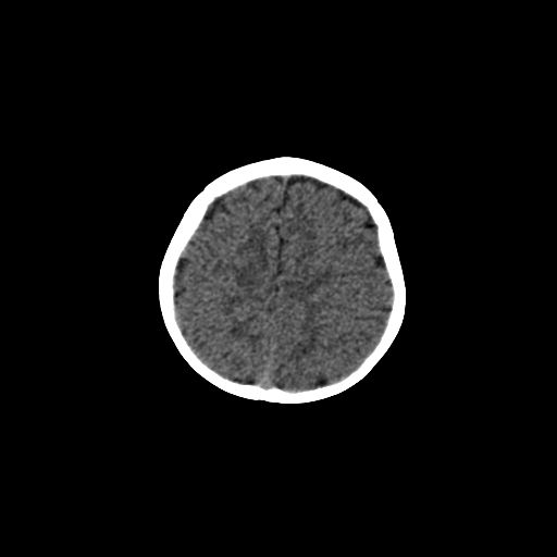 File:Acute phase of hemiconvulsion-hemiplegia epilepsy syndrome (Radiopaedia 29309-29744 Axial non-contrast 11).jpg