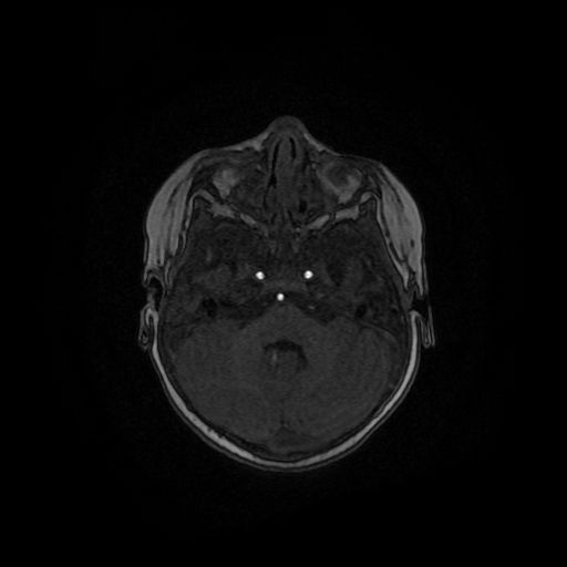 Acute phase of hemiconvulsion-hemiplegia epilepsy syndrome (Radiopaedia 29309-29745 Axial TOF angiography 114).jpg