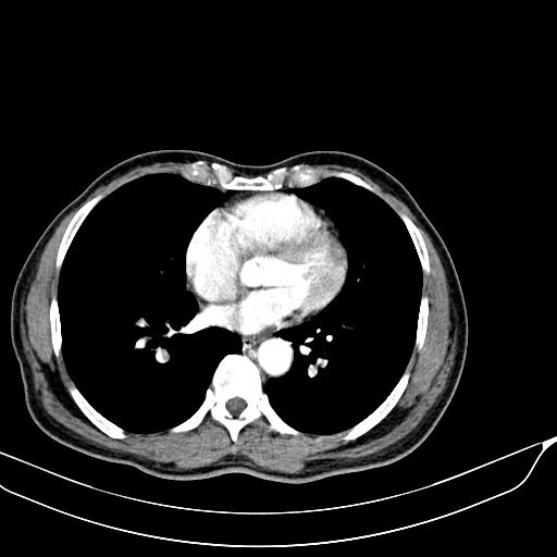 File:Acute pulmonary embolism (Radiopaedia 69510-79390 D 44).jpg