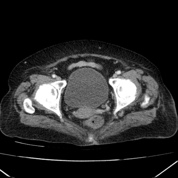 Acute pyelonephritis (Radiopaedia 26584-26729 Axial renal cortical phase 69).jpg
