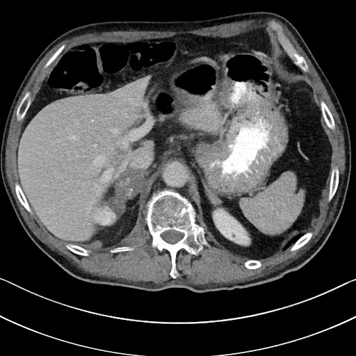 Acute renal infarction - rim capsular enhancement (Radiopaedia 59833-67270 Axial C+ portal venous phase 23).jpg