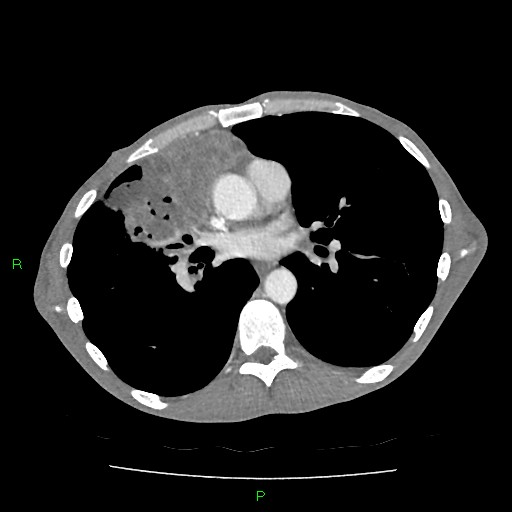 File:Acute right lung abscess (Radiopaedia 34806-36258 Axial C+ arterial phase 100).jpg