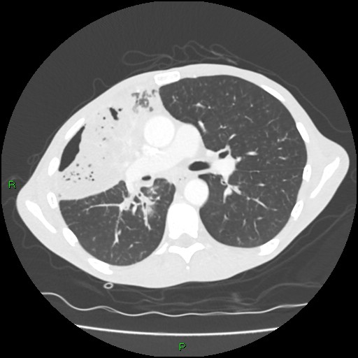 Acute right lung abscess (Radiopaedia 34806-36258 Axial lung window 85).jpg