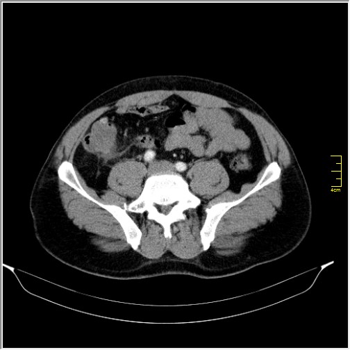 Acute right sided diverticulitis (Radiopaedia 65249-74268 Axial C+ portal venous phase 54).JPG