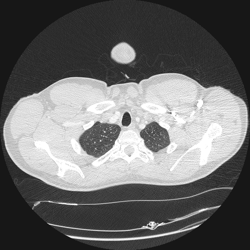 File:Acute segmental pulmonary emboli and pulmonary infarction (Radiopaedia 62264-70444 Axial lung window 12).jpg
