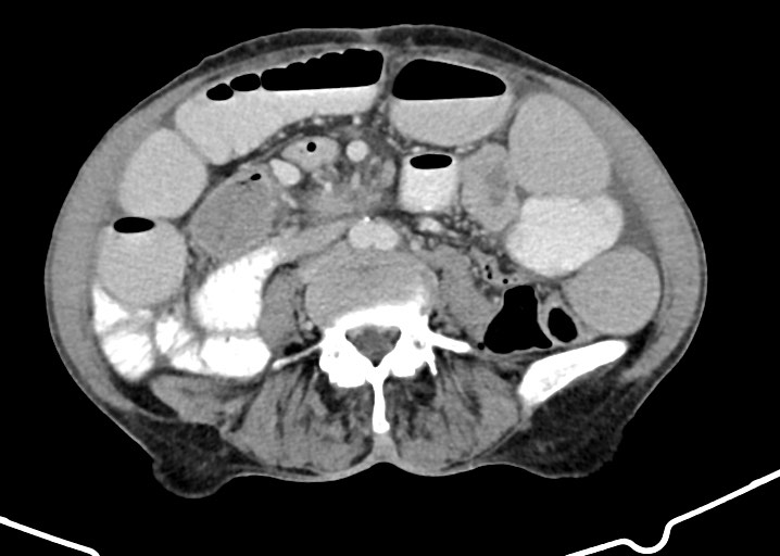 Acute small bowel (ileal) volvulus (Radiopaedia 71740-82139 Axial C+ portal venous phase 122).jpg