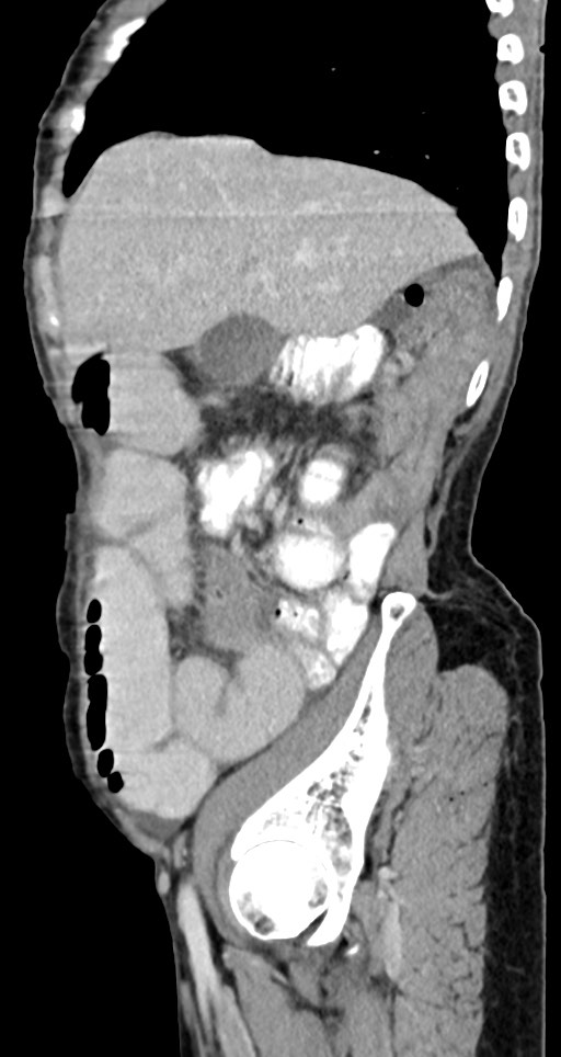 Acute small bowel (ileal) volvulus (Radiopaedia 71740-82139 Sagittal C+ portal venous phase 122).jpg