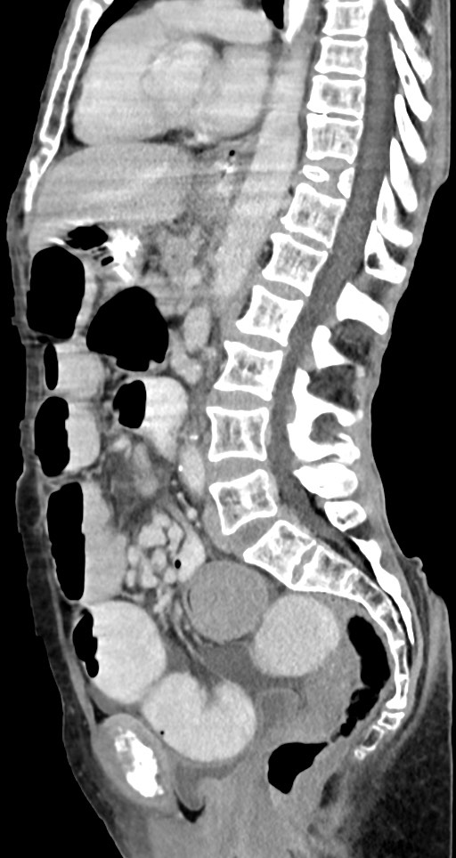 Acute small bowel (ileal) volvulus (Radiopaedia 71740-82139 Sagittal C+ portal venous phase 84).jpg