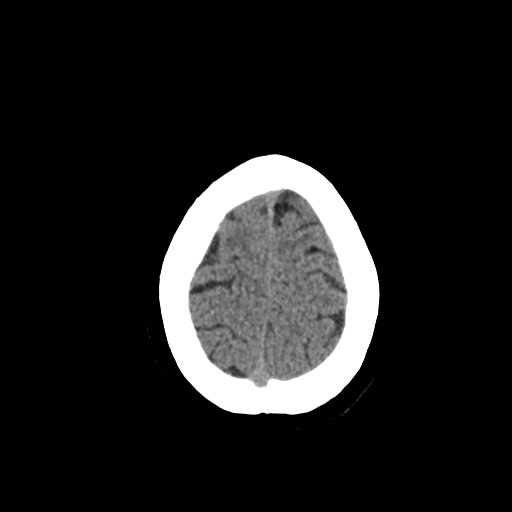 Acute subarachnoid hemorrhage and accessory anterior cerebral artery (Radiopaedia 69231-79008 Axial non-contrast 48).jpg