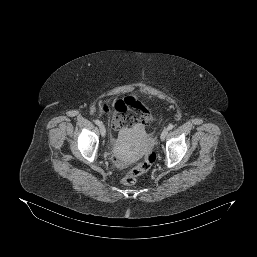 File:Acute superior mesenteric artery occlusion (Radiopaedia 51288-56960 Axial C+ portal venous phase 90).jpg