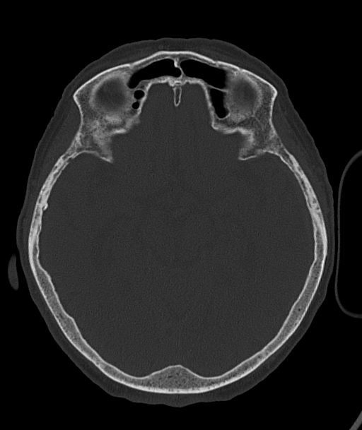 Acute traumatic subdural hematoma (Radiopaedia 82921-97257 Axial bone window 65).jpg