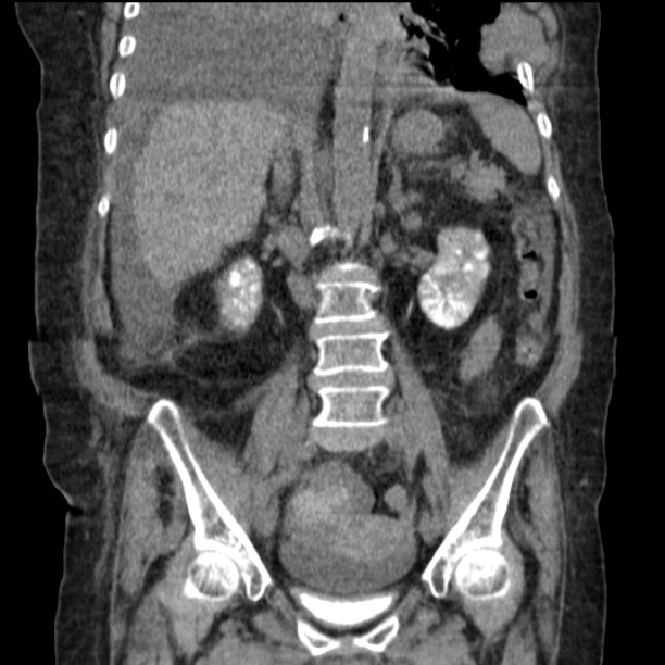 Acute tubular necrosis (Radiopaedia 28077-28334 D 50).jpg