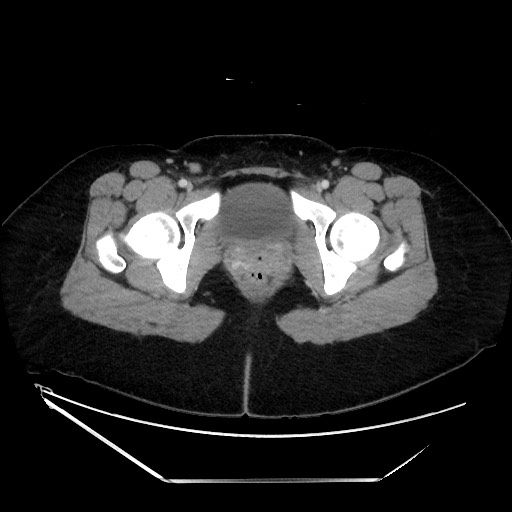 Acute uncomplicated appendicitis (Radiopaedia 73704-84499 Axial C+ portal venous phase 160).jpg