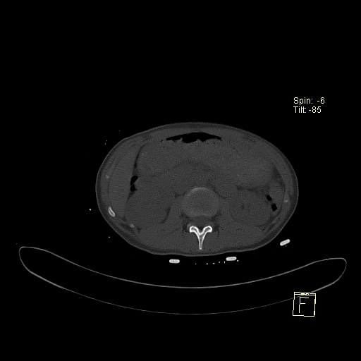 File:Acute vertebral compression fracture (Radiopaedia 63832-72559 Axial bone window 22).jpg