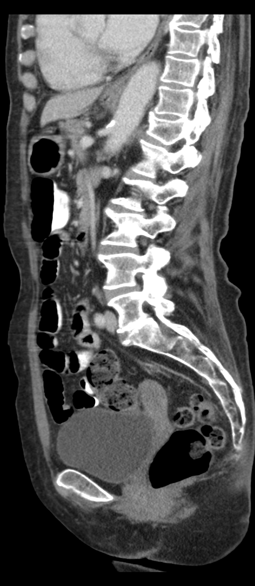 Adenocarcinoma of cecum (Radiopaedia 59222-66549 Sagittal C+ portal venous phase 39).jpg