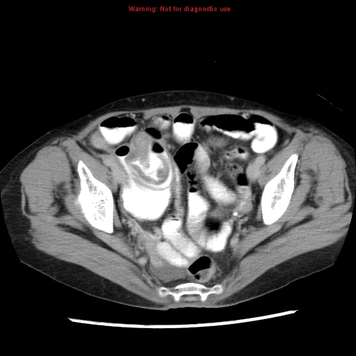 Adenocarcinoma of the colon (Radiopaedia 8191-9039 Axial renal excretory phase 51).jpg