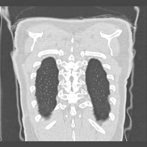 Adenocarcinoma of the lung (Radiopaedia 59871-67325 Coronal lung window 61).jpg