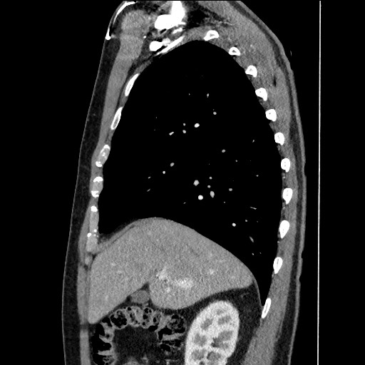 Adenocarcinoma of the lung (Radiopaedia 59871-67325 Sagittal C+ arterial phase 27).jpg