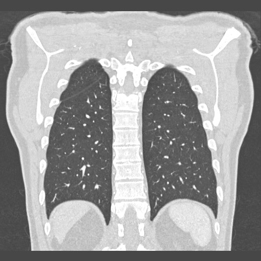 Adenocarcinoma of the lung (Radiopaedia 59871-67325 Sagittal lung window 2).jpg