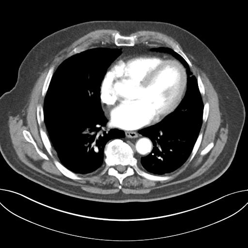 Adenocarcioma of rectum- T1 lesion (Radiopaedia 36921-38547 Axial C+ arterial phase 35).png