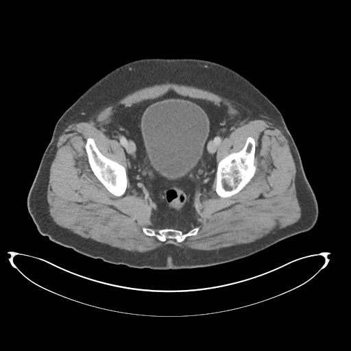 Adenocarcioma of rectum- T1 lesion (Radiopaedia 36921-38547 Axial C+ portal venous phase 77).png