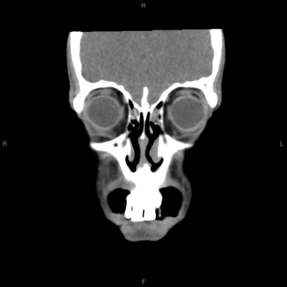 File:Adenoid cystic carcinoma of hard palate (Radiopaedia 26137-26273 Coronal liver window 4).jpg