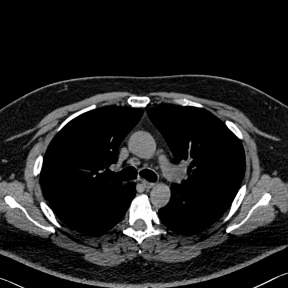 File:Adenoid cystic carcinoma of the trachea (Radiopaedia 49042-54137 Axial non-contrast 126).jpg