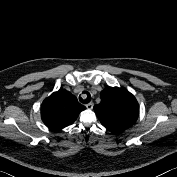 File:Adenoid cystic carcinoma of the trachea (Radiopaedia 49042-54137 Axial non-contrast 55).jpg