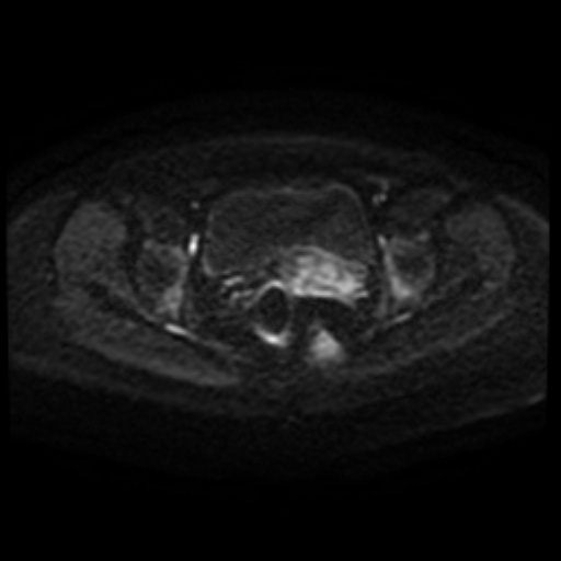 Adenoma malignum of cervix (Radiopaedia 66441-75705 Axial DWI 90).jpg