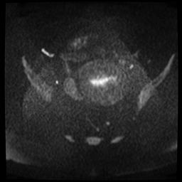 File:Adenomyosis-scar endometriosis (Radiopaedia 65863-75022 Axial DWI 5).jpg