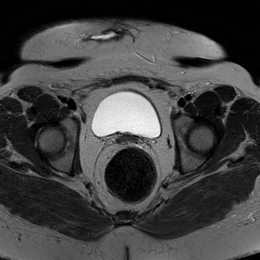 File:Adenomyosis within a didelphys uterus (Radiopaedia 70175-80215 Axial T2 25).jpg