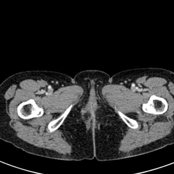 Adhesional small bowel obstruction (Radiopaedia 48397-53305 Axial C+ portal venous phase 103).jpg